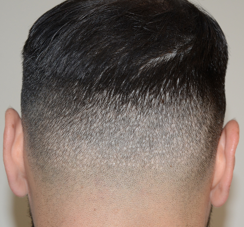 SMP- scalp micropigmentation- done into prior FUE donor site before photo