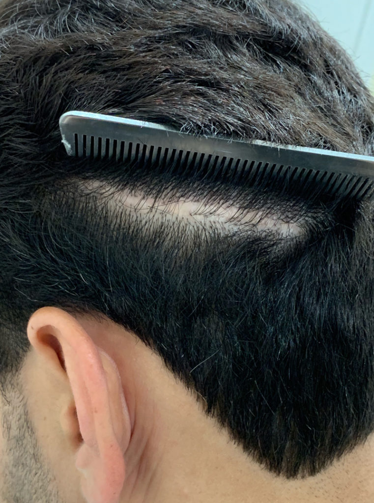 SMP - scalp micropigmentation - used to improve the appearance of a prior widened linear donor site scar back before view