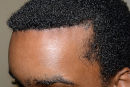 This African American patient in his late 20s desired a lower hairline, so he underwent a surgical hairline advancement (SHA) that brought forth his hairline a full 1 ½ inch, or more than 35mm oblicue after view