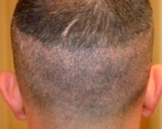 Male Hair Transplant Two days after