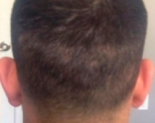 Male Hair Transplant Seven days after