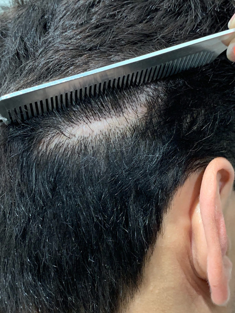 Scalp micropigmentation before man oblicue view picture