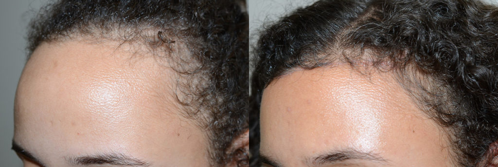 Before and after hairline lowering surgery, where the forehead was reduced in height by almost 1 ¾ inches.