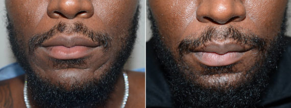 Trasplante de Pelo Facial Before and after in Miami, FL, Paciente 108329