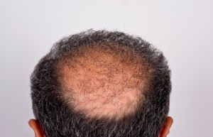 Hair Transplant
