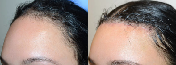 Trasplante de Pelo en Mujeres Before and after in Miami, FL, Paciente 117275