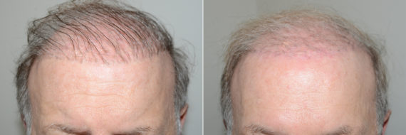 Reparación Capilar Before and after in Miami, FL, Paciente 118758