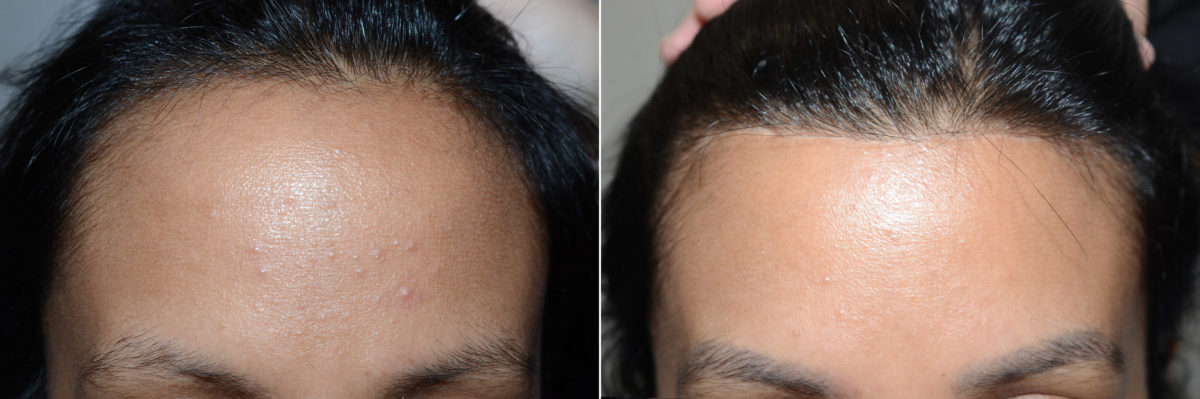 Forehead Reduction Surgery Before and after in Miami, FL, Paciente 118806