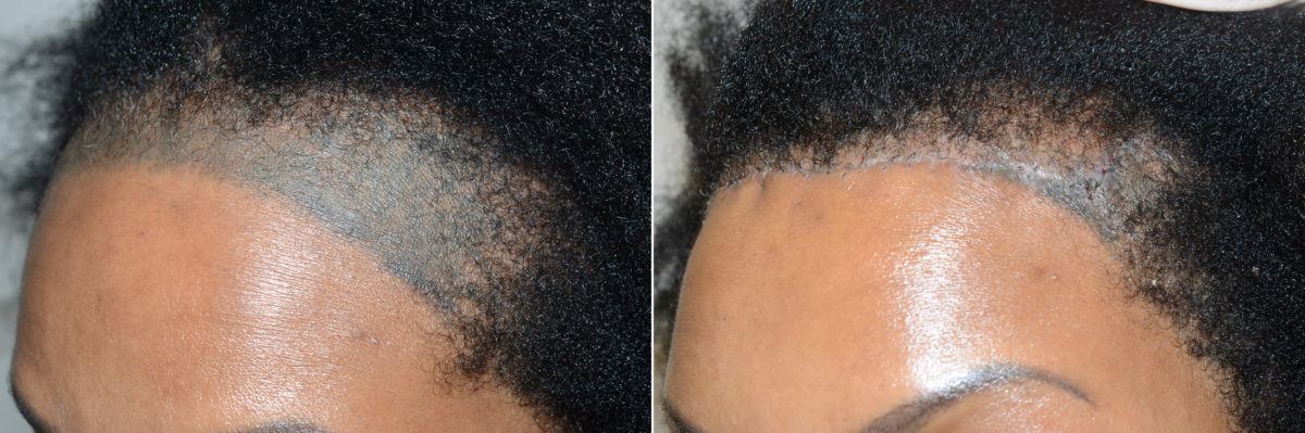 Adelanto de Línea Capilar Antes y después en Miami, FL, Paciente 118840