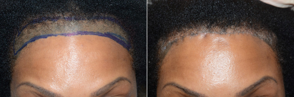 Adelanto de Línea Capilar Antes y después en Miami, FL, Paciente 118840