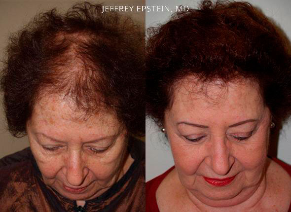 Woman Hair replacement frontal view before and after photo patient 1