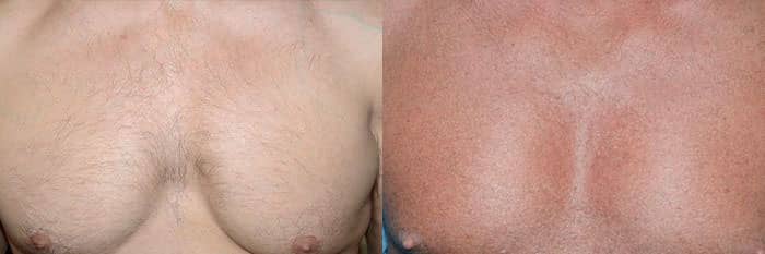 Before chest view BHT from the chest transplanted to an old donor site scar, with minimal detectable scarring of the chest after healing