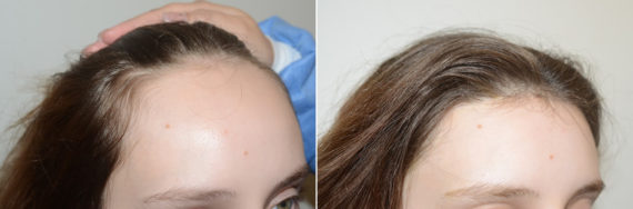 Forehead Reduction Surgery Before and after in Miami, FL, Paciente 123406