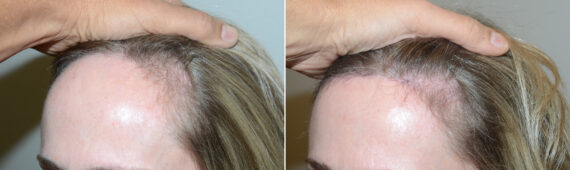 Forehead Reduction Surgery Before and after in Miami, FL, Paciente 124414