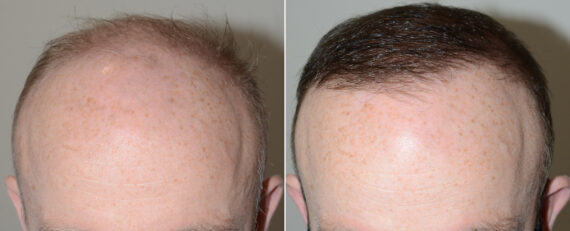 Body Hair Transplant Before and after in Miami, FL, Paciente 110728