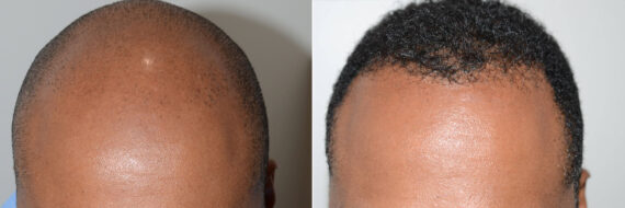 Hair Transplants for Men Before and after in Miami, FL, Paciente 120459