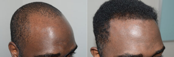 Hair Transplants for Men Before and after in Miami, FL, Paciente 123113