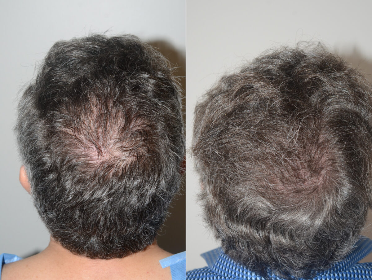 Body Hair Transplant Before and after in Miami, FL, Paciente 123219