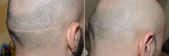 Donor Site Transplant Close Ups Before and after in Miami, FL, Paciente 58977