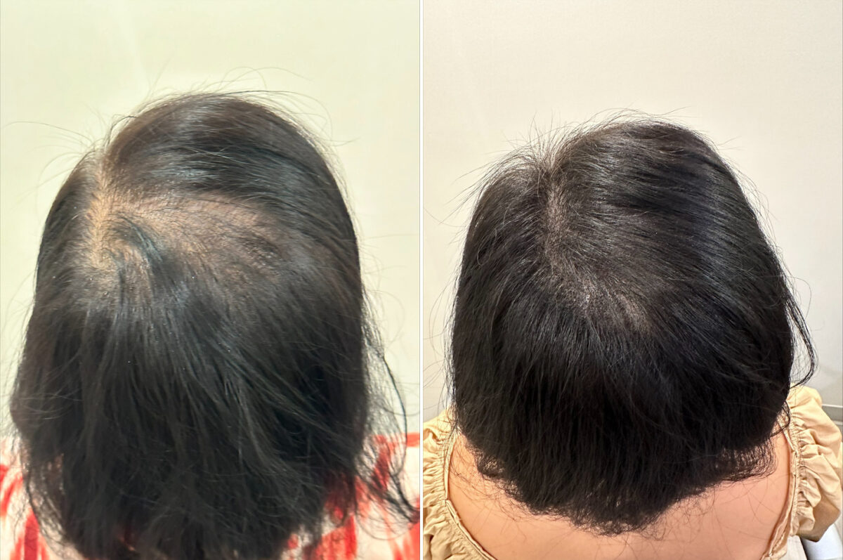 Scalp Micropigmentation Before and after in Miami, FL, Paciente 125295