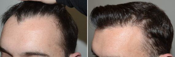 Hair Transplants for Men Before and after in Miami, FL, Paciente 125601