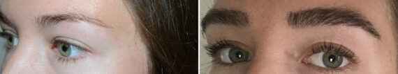 Eyebrow Hair Transplant Before and after in Miami, FL, Paciente 125633