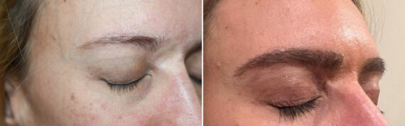 Eyebrow Hair Transplant Before and after in Miami, FL, Paciente 125878
