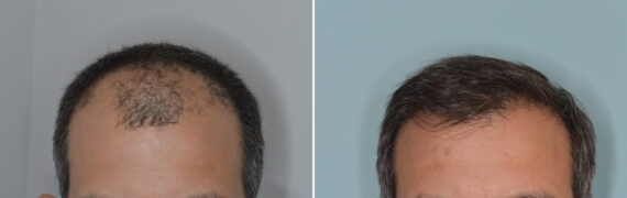 Hair Transplants for Men Before and after in Miami, FL, Paciente 126399