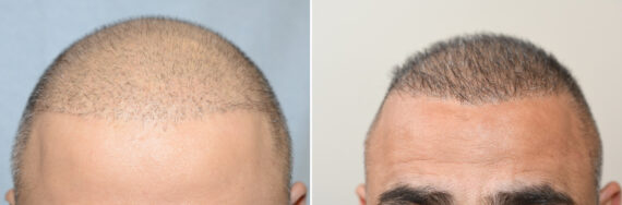 Body Hair Transplant Before and after in Miami, FL, Paciente 126515