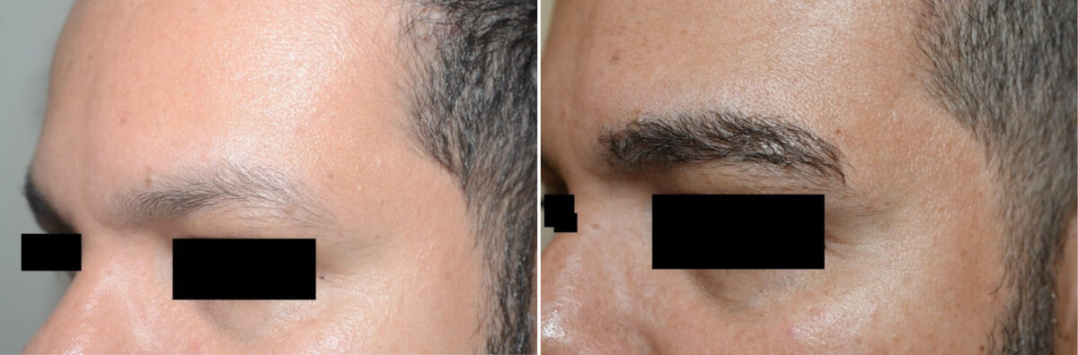 Eyebrow Hair Transplant Before and after in Miami, FL, Paciente 126567
