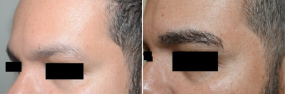 Eyebrow Hair Transplant Before and after in Miami, FL, Paciente 126567