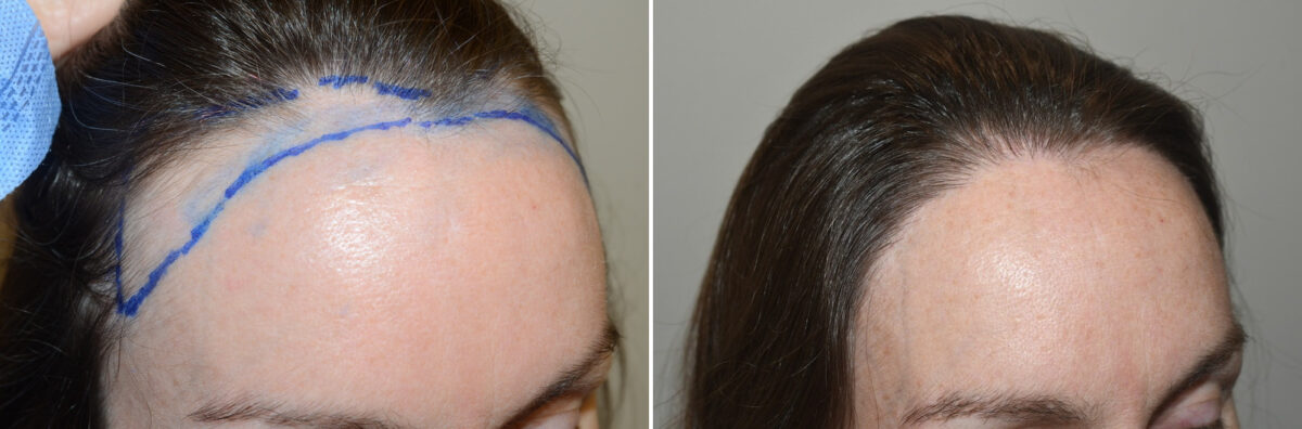 Hair Transplants for Women Before and after in Miami, FL, Paciente 126894